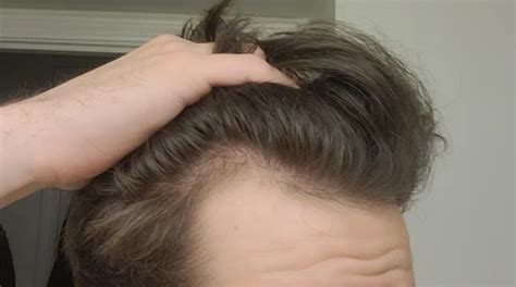 A lot of graduate students, for example, get temporary baldness during their studies. . Balding in 20s dating reddit